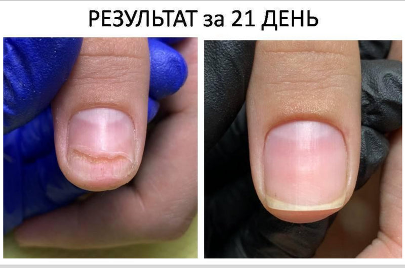 MEDICALIMA MICOZEN 77 Nagų skystis onicholizei gydyti